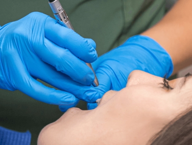 Replacement of amalgam fillings