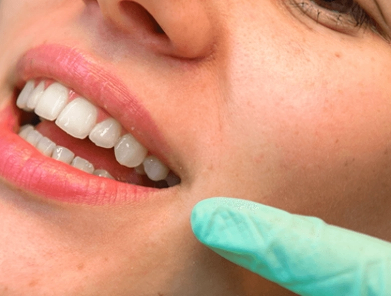 Biolase laser tooth whitening