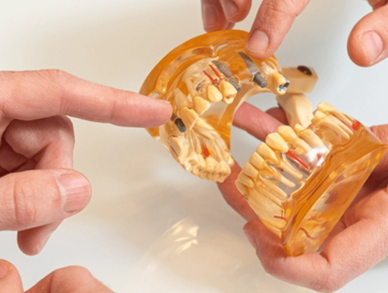 Dental implants, tooth replacement with implants, implant prices
