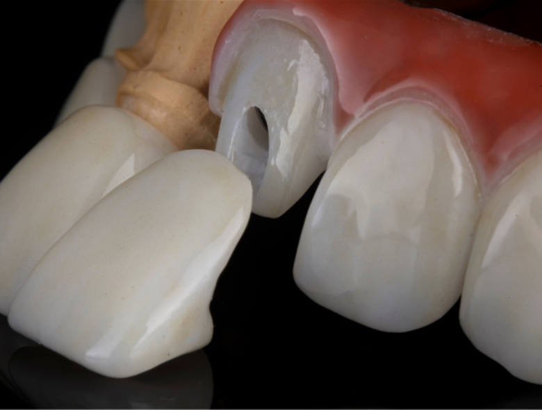  Fémmentes fogpótlás: a tökéletes alternatíva fémallergia esetén