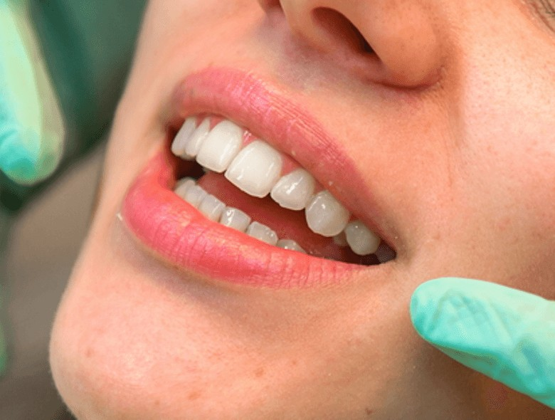 Lézeres ínyesztétika, ínyvisszahúzódás kezelése