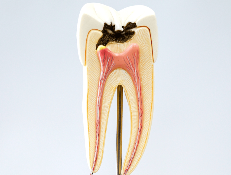 Milyen szövődményeket okozhat egy lyukas fog?