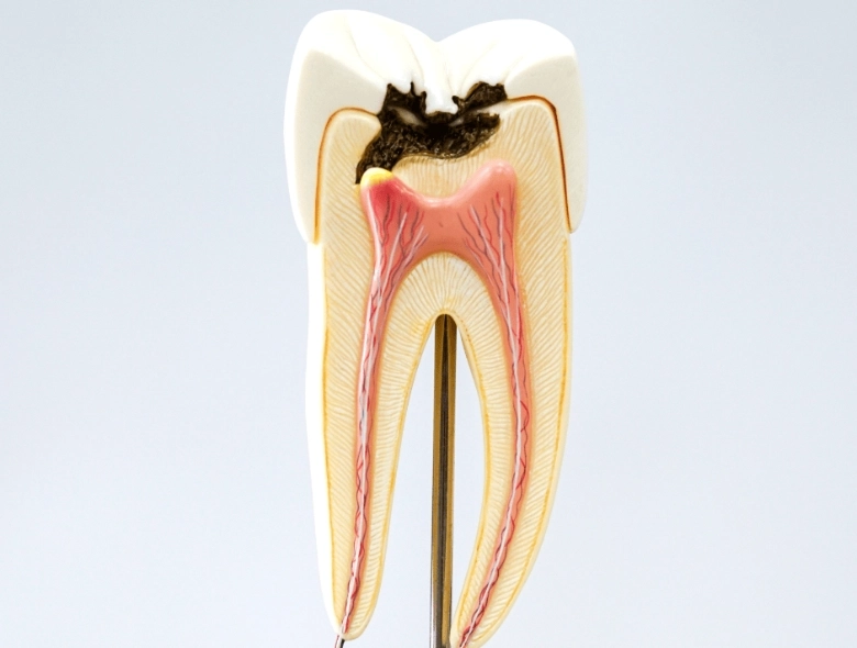 Milyen szövődményeket okozhat egy lyukas fog?