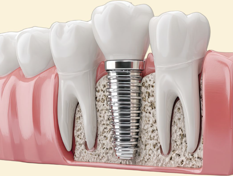 Mennyire fáj a fog implantátum?