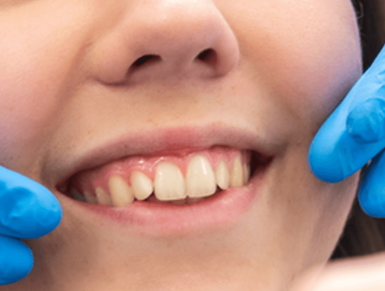 Tooth restoration - invisible filling