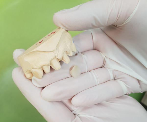 A fogorvos egy lecsiszolt fogat tart a kezében, amivel prezentálja a páciensnek a folyamatot
